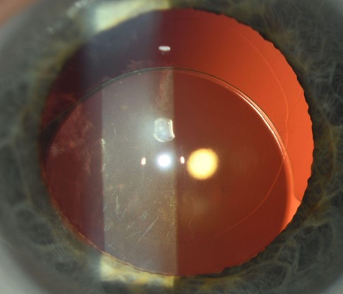 <p>Lens Dislocation. This image shows out-of-bag intraocular lens dislocation.</p>