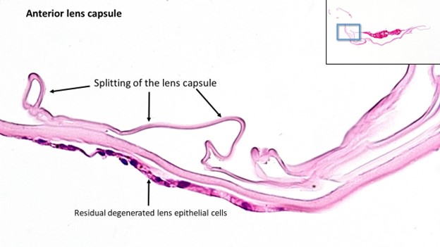 <p>Lens Capsule Splitting