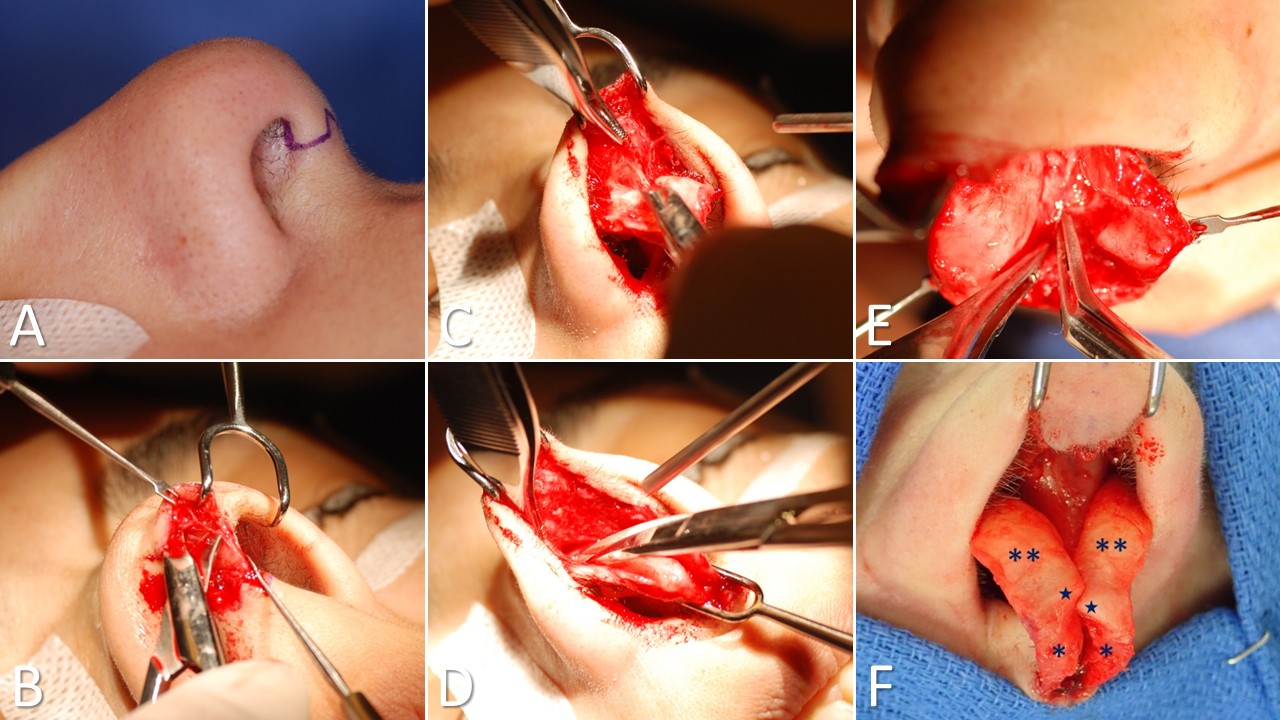 <p>Open Rhinoplasty Approach