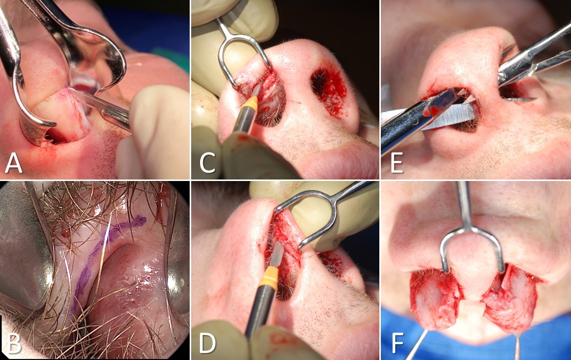 <p>Tip-Delivery Rhinoplasty