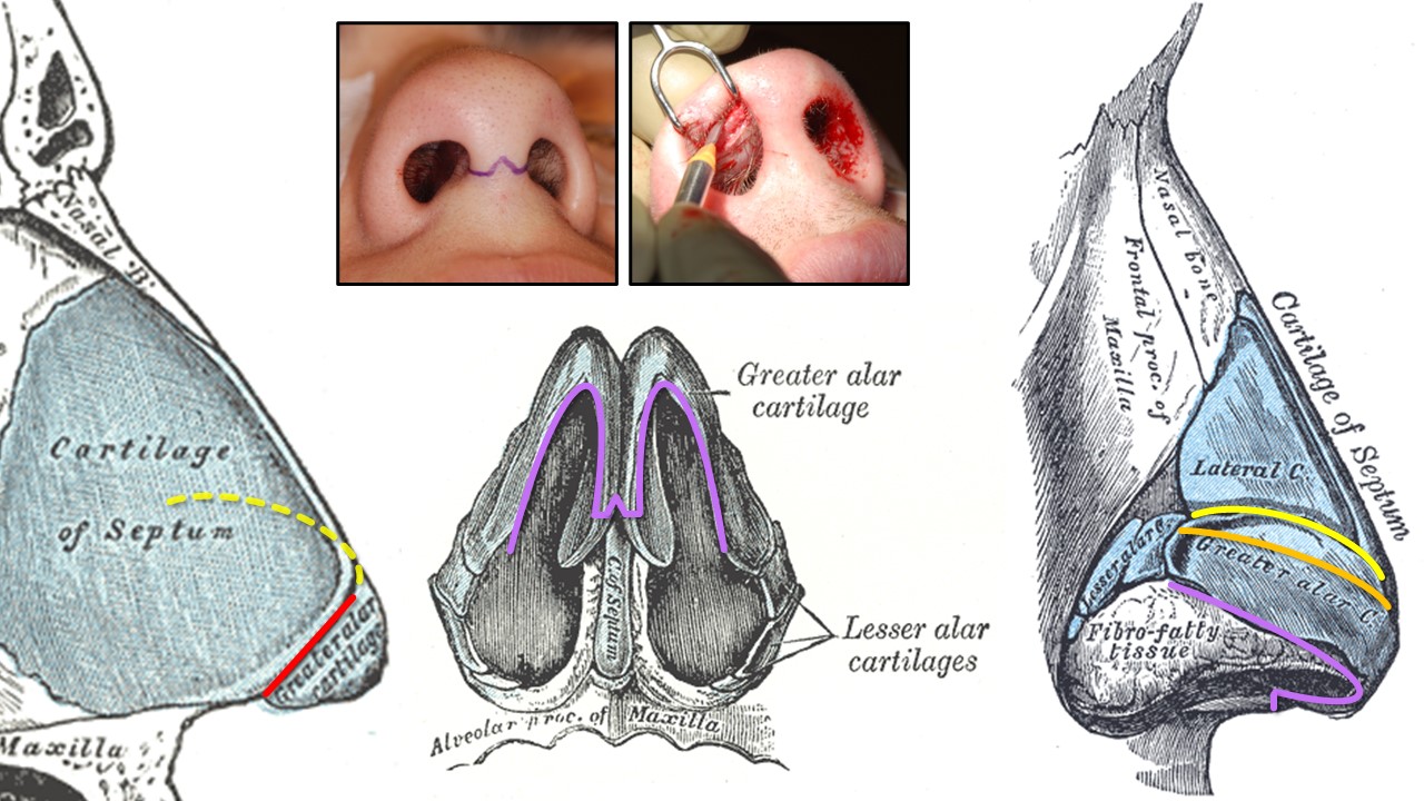 <p>Rhinoplasty Incisions