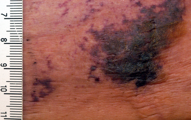 <p>Calciphylaxis