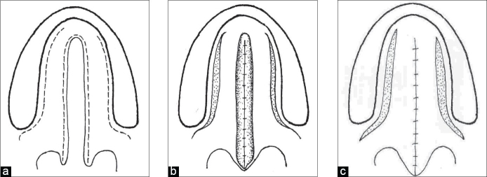 <p>Von Langenbeck Palatoplasty Diagram