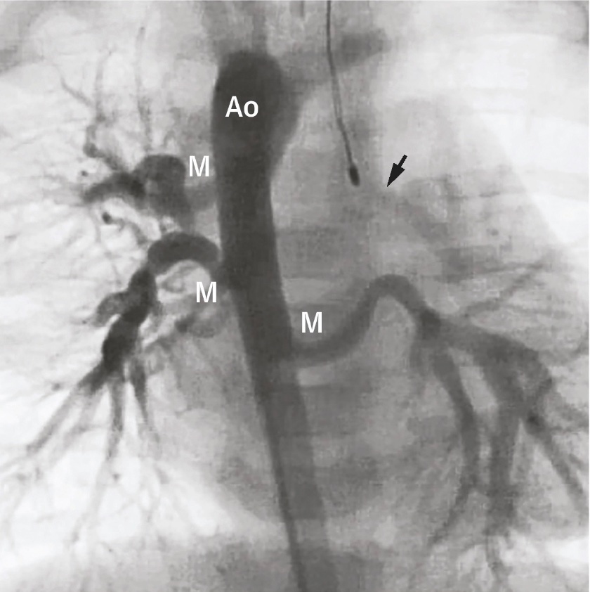 <p>Major Aortopulmonary Collateral Arteries Angiogram