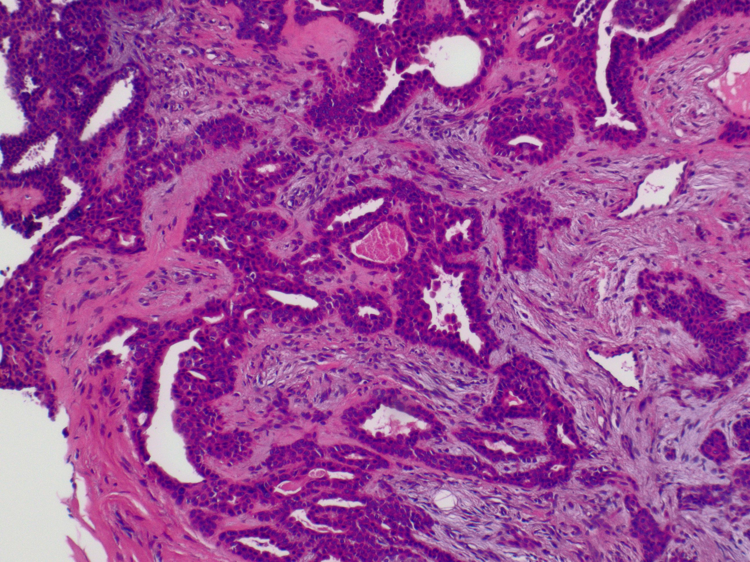 <p>Cutaneous Mixed Tumor at 10x Magnification