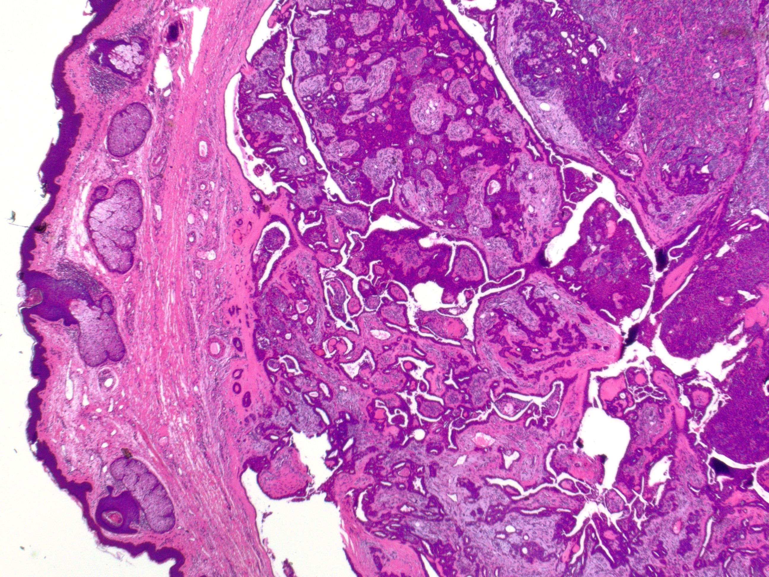 <p>Cutaneous Mixed Tumor at 2x Magnification