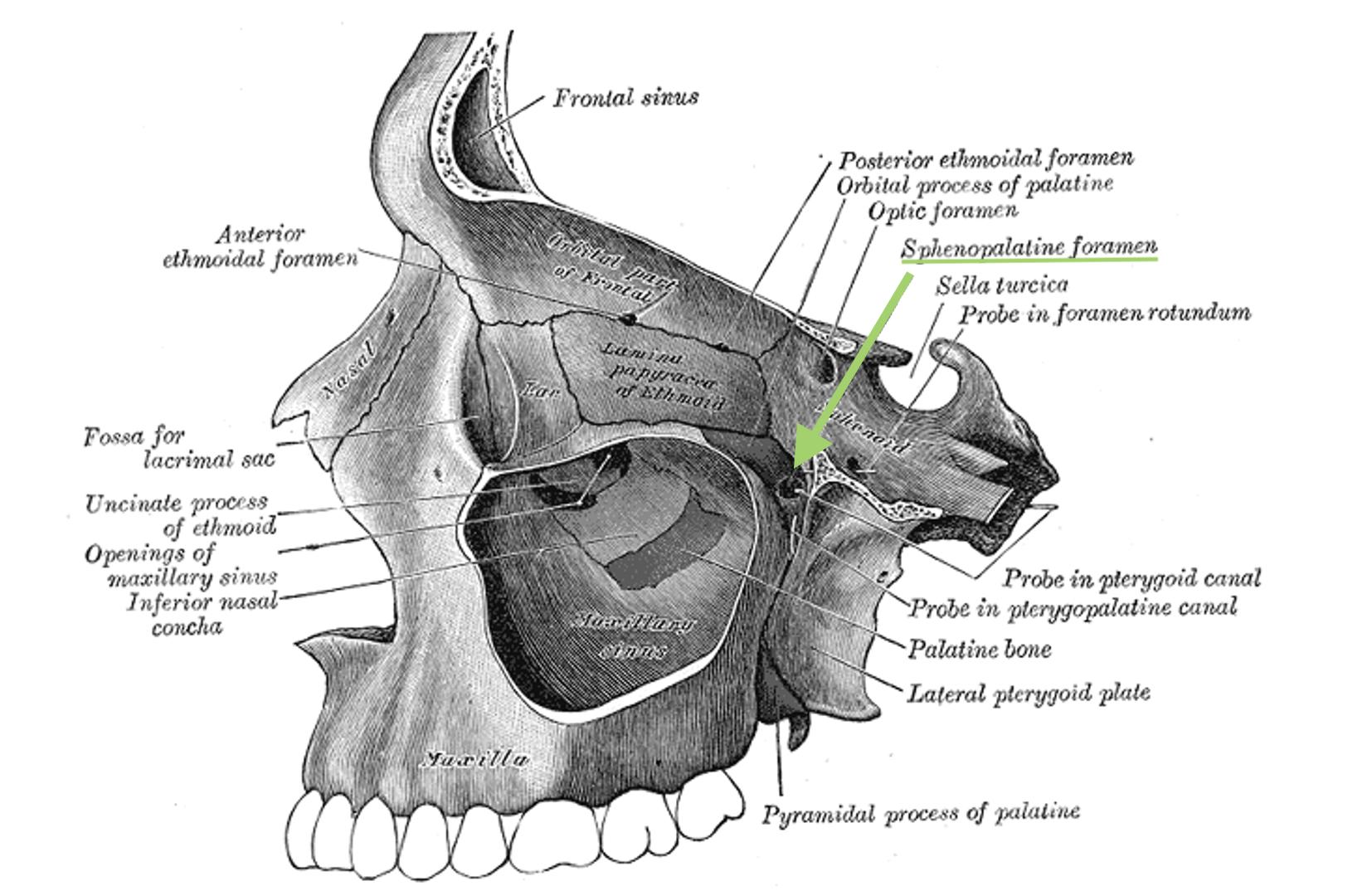 <p>Sphenopalatine Foramen. This image shows the sphenopalatine foramen's location and anatomical relationships.</p>