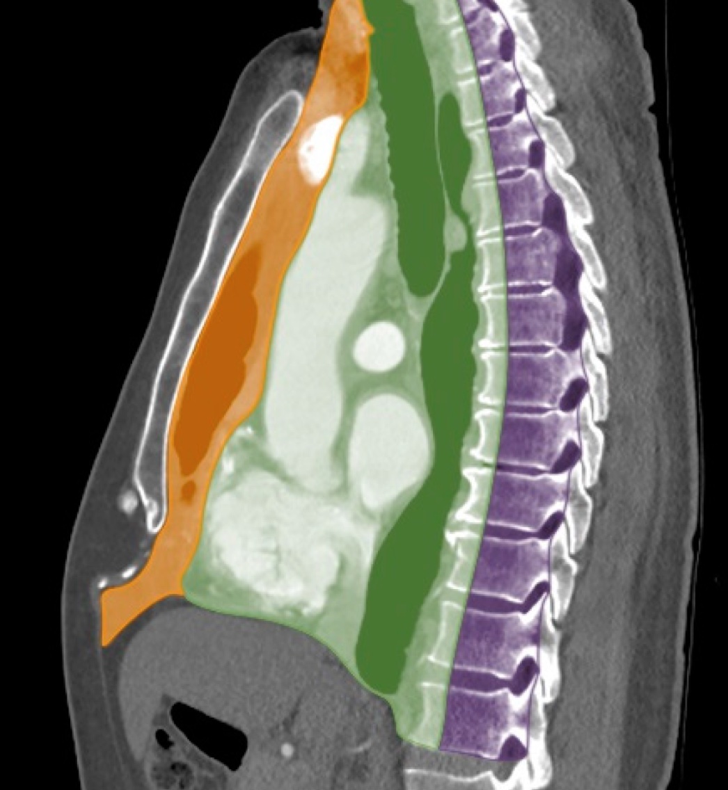 <p>Mediastinum, Computed Tomography Scan