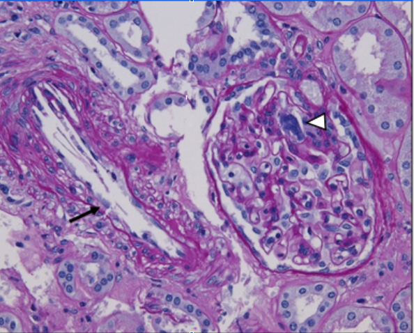 <p>Cholesterol Emboli in the Glomerulus, Histology, PAS
