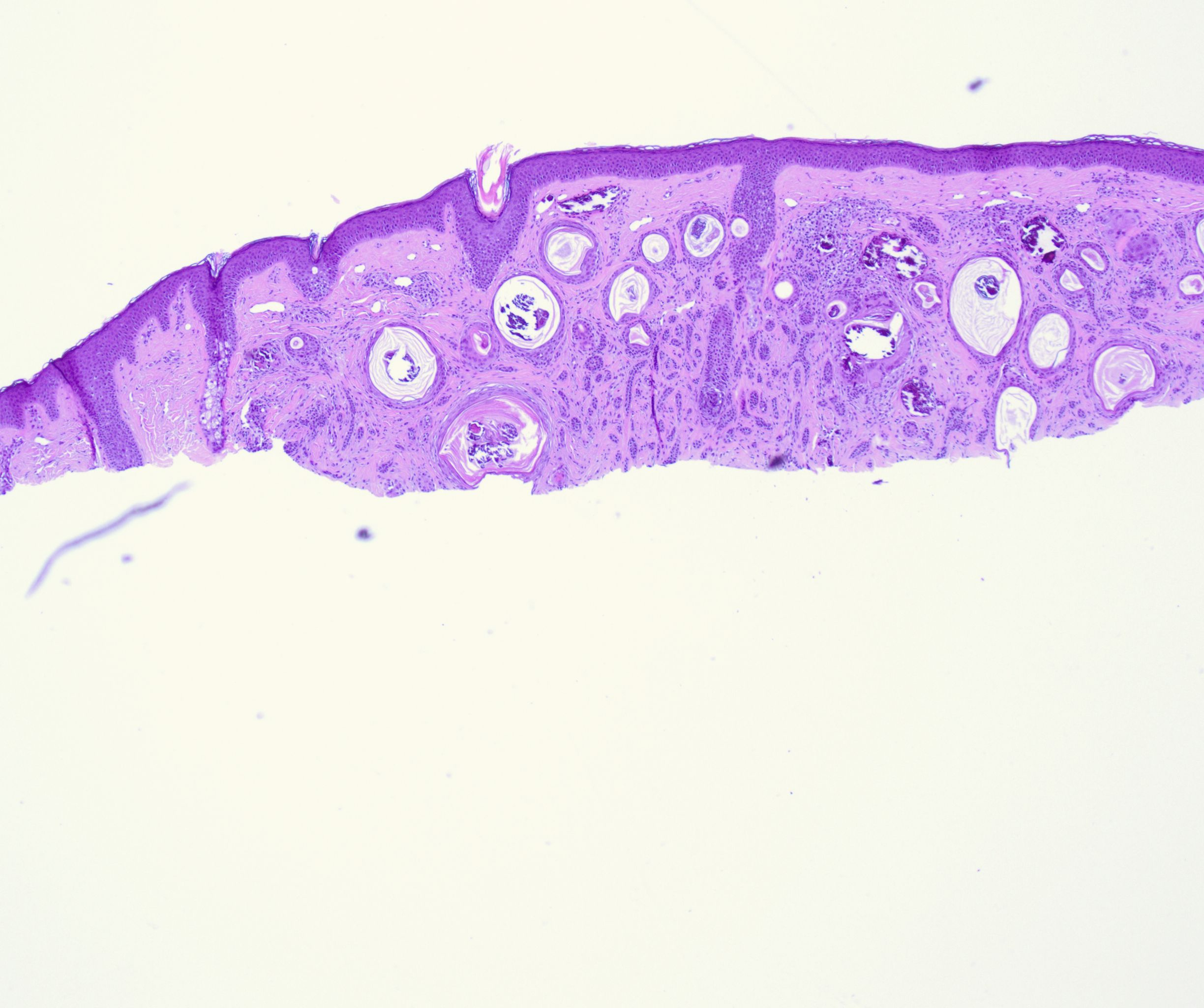 <p>Histopathology of a Desmoplastic Trichoepithelioma at Low Power.</p>