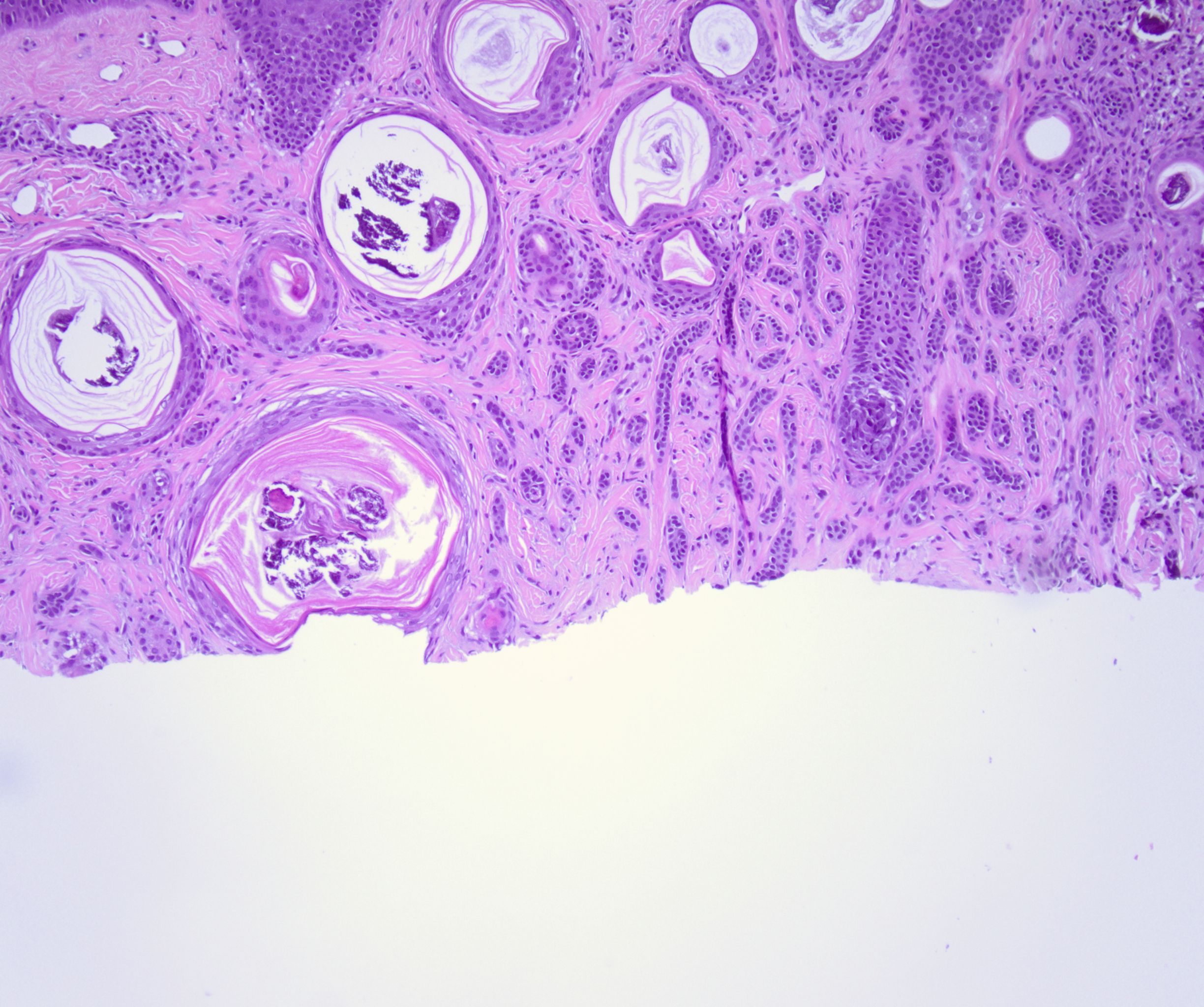 <p>Histopathology of a Desmoplastic Trichoepithelioma at Medium Power.</p>