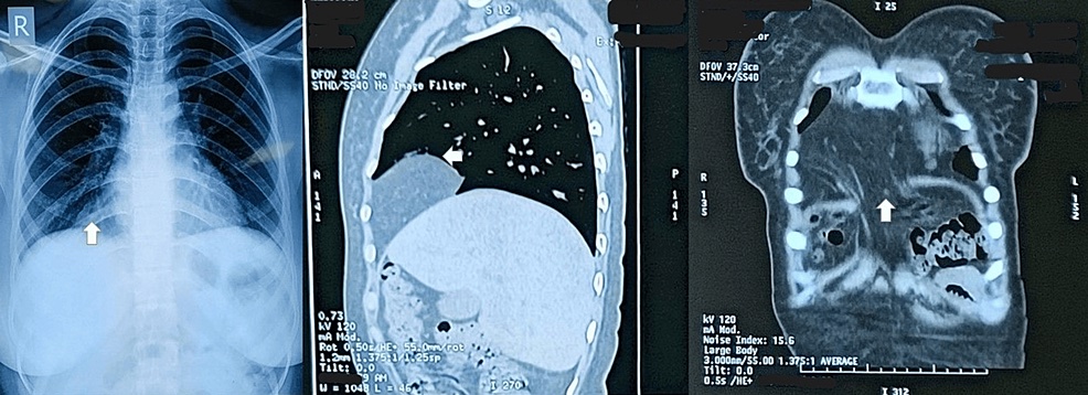 <p>Morgagni Hernia&nbsp;on Radiography