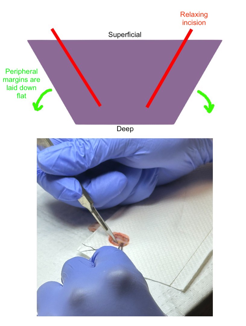 <p>Relaxing Incision