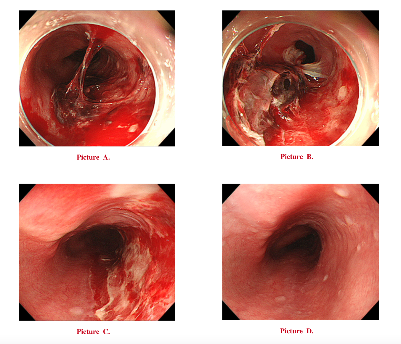<p>Progression and Healing Stages of&nbsp;Esophageal Hematoma