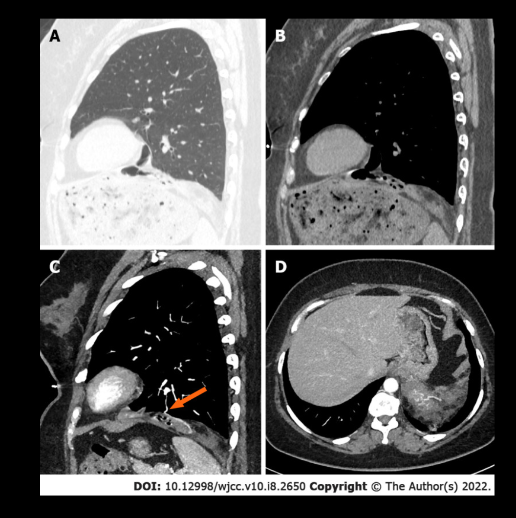 <p>Large Pulmonary Hamartoma