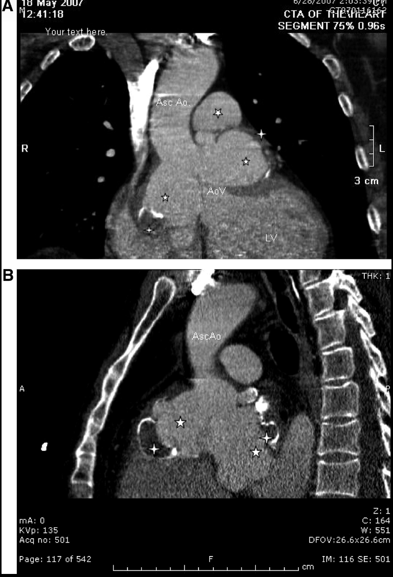 <p>Sinus of Valsalva Aneurysm