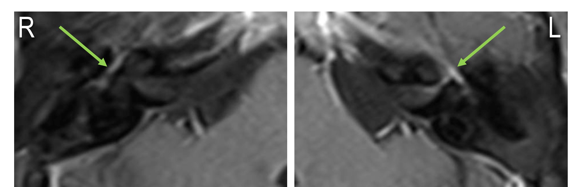 <p>Left-Sided Bell Palsy, Magnetic Resonance Image