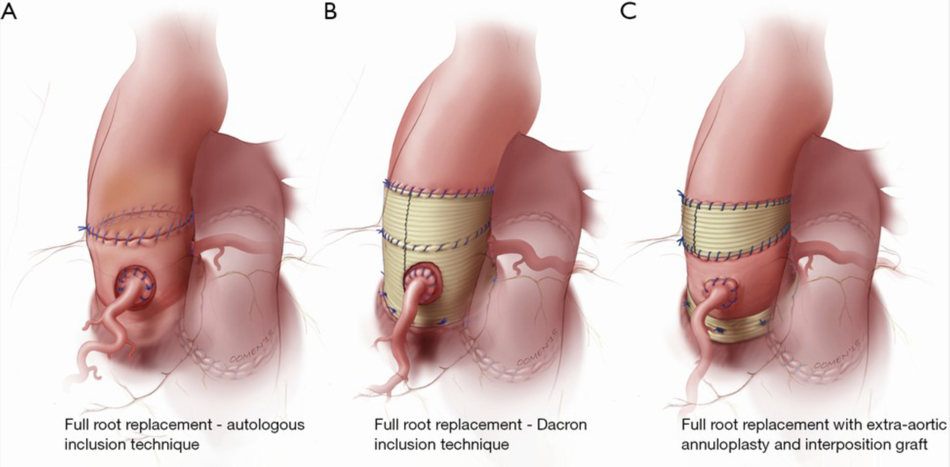 <p>Ross Procedure