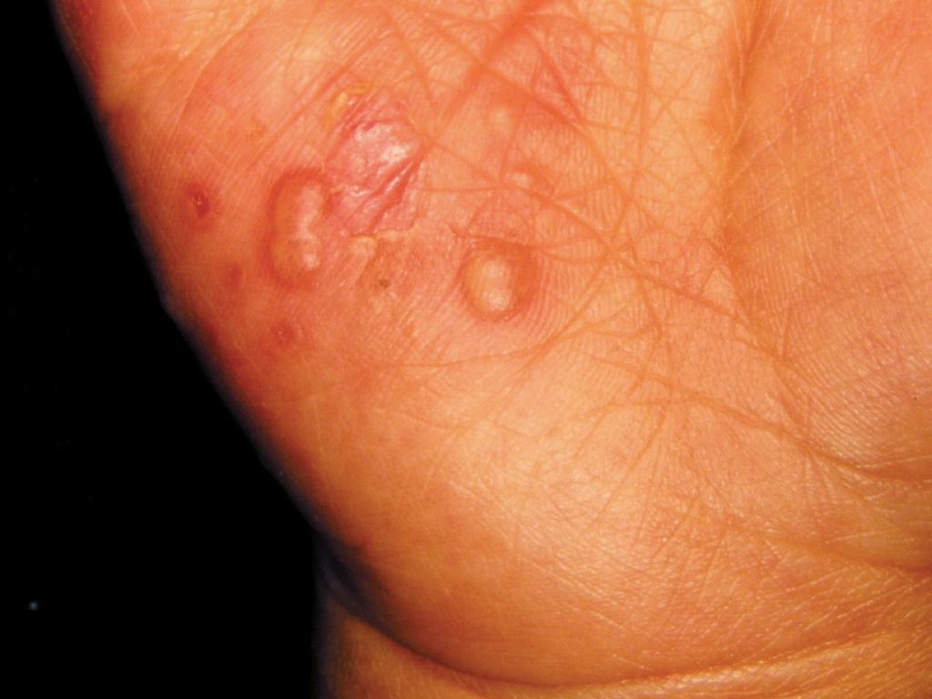 <p>Hand, Foot, and Mouth Disease.</p>