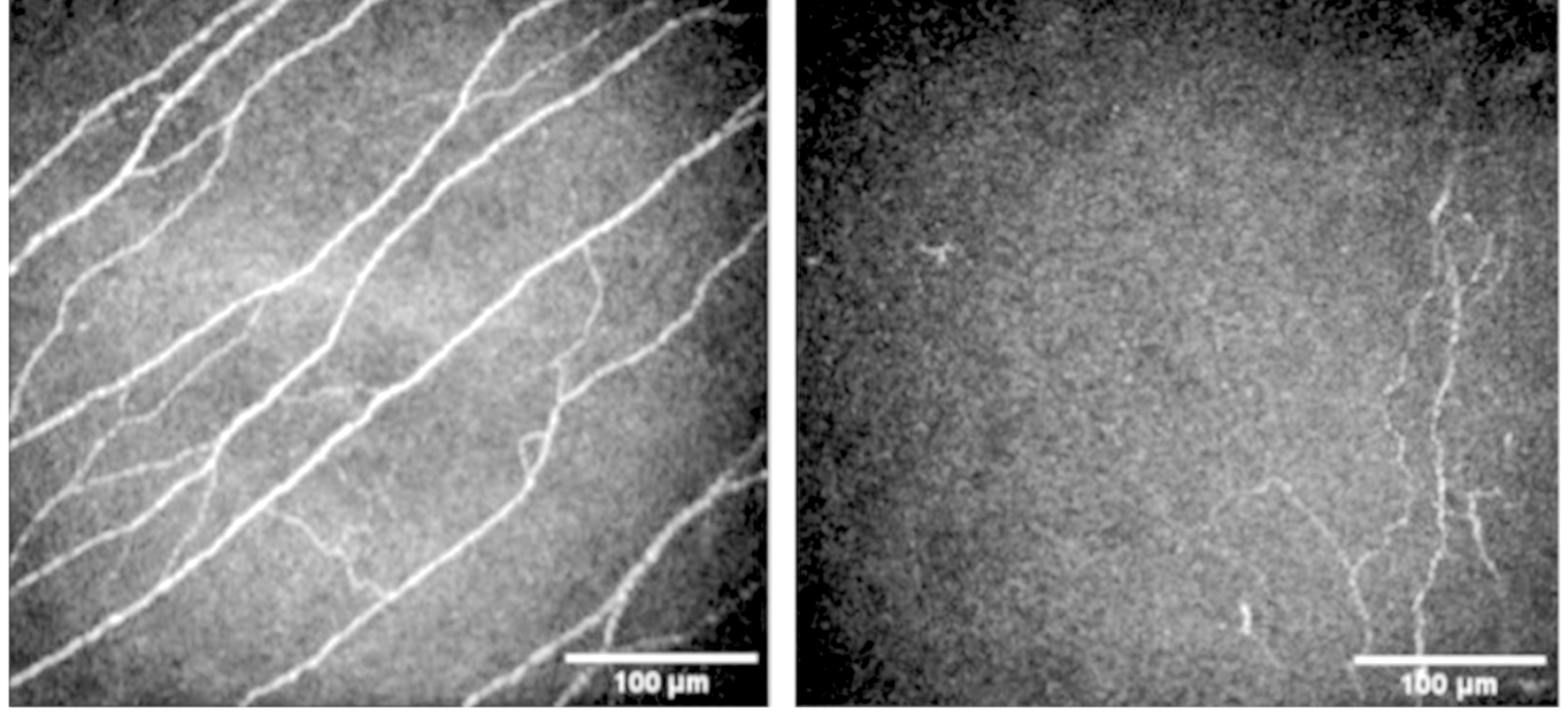 <p>Neurotrophic Cornea