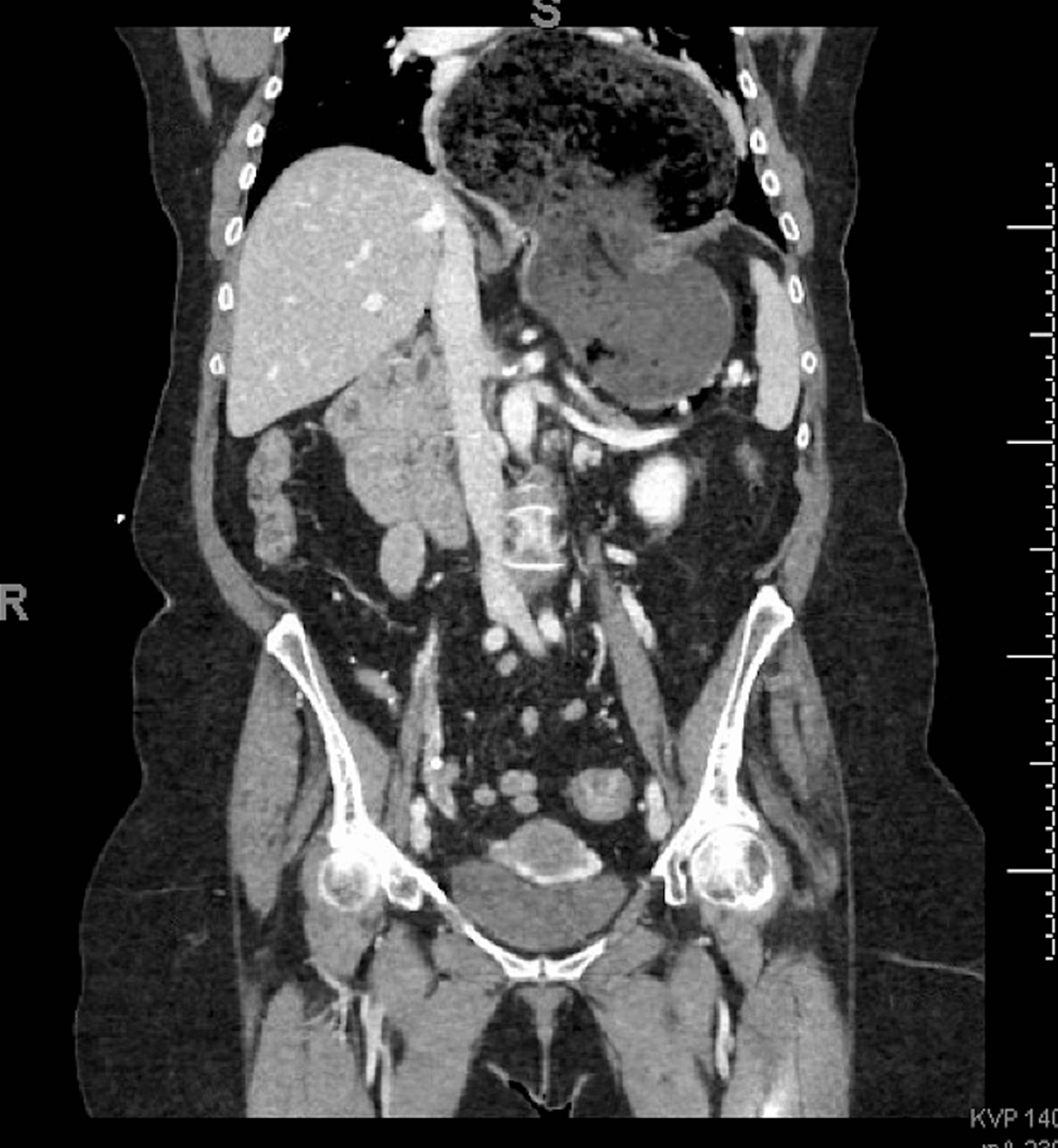 <p>Massive Hiatal Hernia