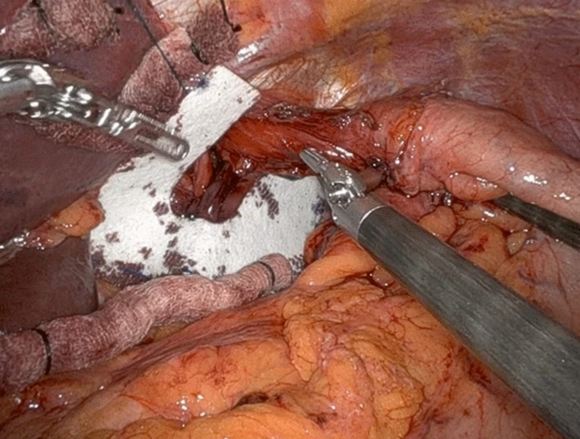 <p>Wrap and Mesh for Hiatal Hernia Surgery. This image shows a U-shaped-configuration mesh for hiatal hernia repair.</p>