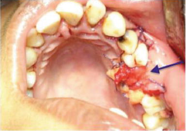 <p>Buccal Advancement Flap