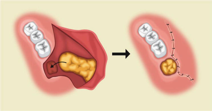 <p>Buccal Fat Pad With Buccal Advancement Flap