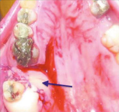 <p>Palatal Advancement Flap