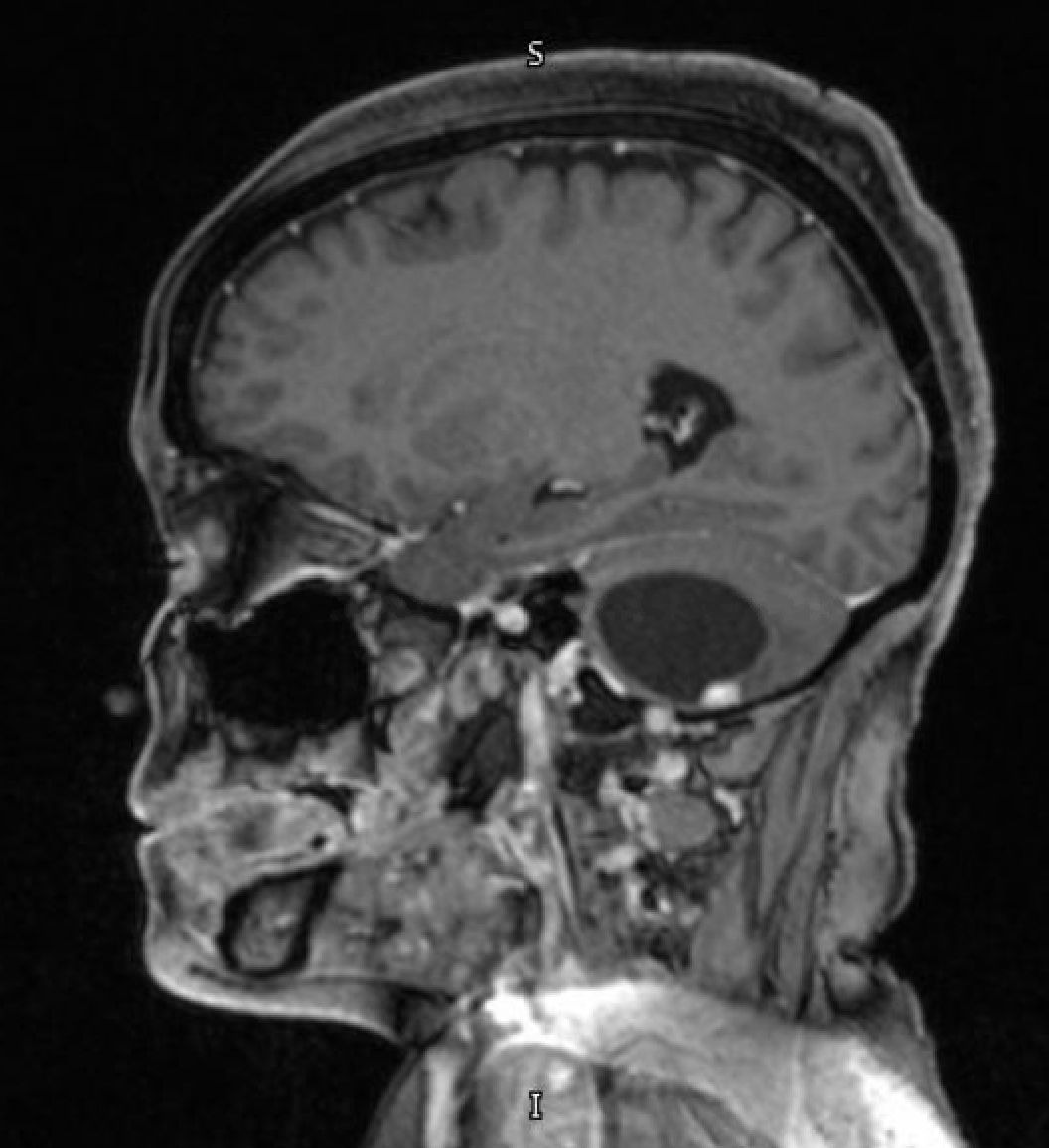 <p>Sagittal MRI Head With Contrast