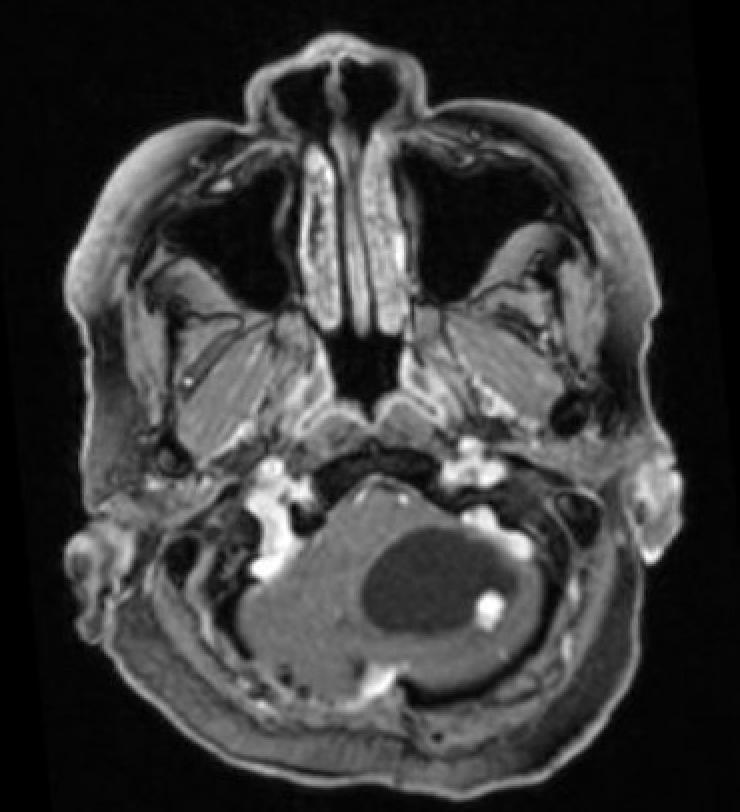 <p>Axial MRI Head With Contrast