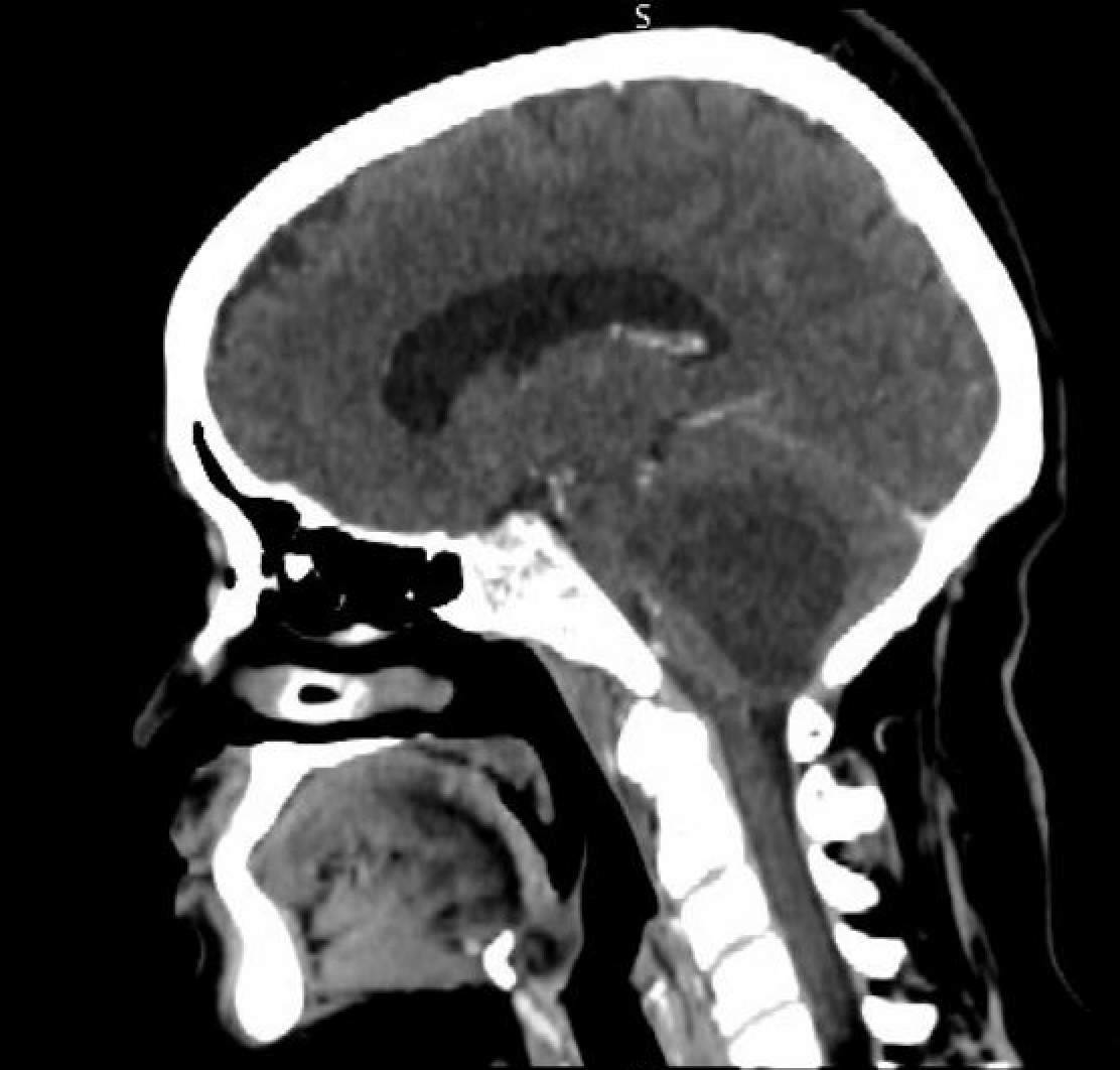 <p>Computed tomography With Contrast. Sagittal view of a hemangioblastoma on computed tomography.</p>