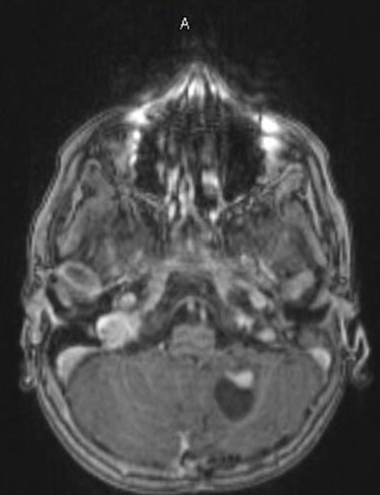 <p>Pilocytic Astrocytoma. Sagittal and axial MRI images show a left cystic lesion with an enhancing nodule.</p>