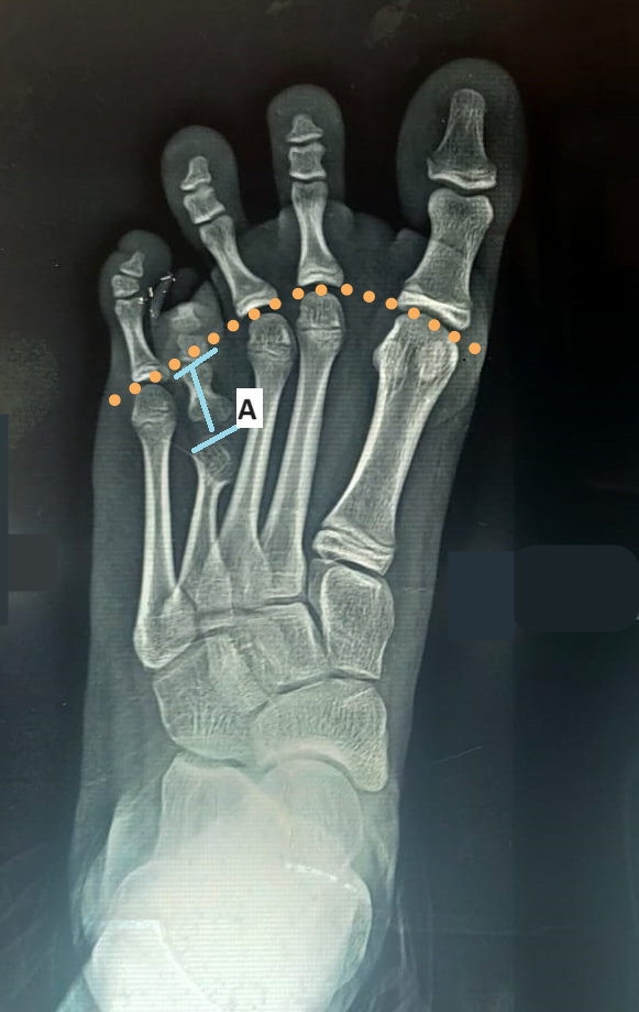 <p>Metatarsal Head Parabolas Depicting Brachymetatarsia