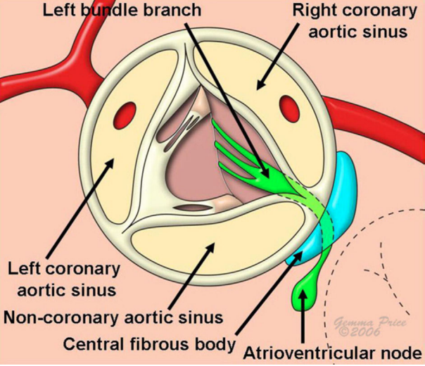 <p>Complex Anatomy of the Left Ventricular Outflow Tract