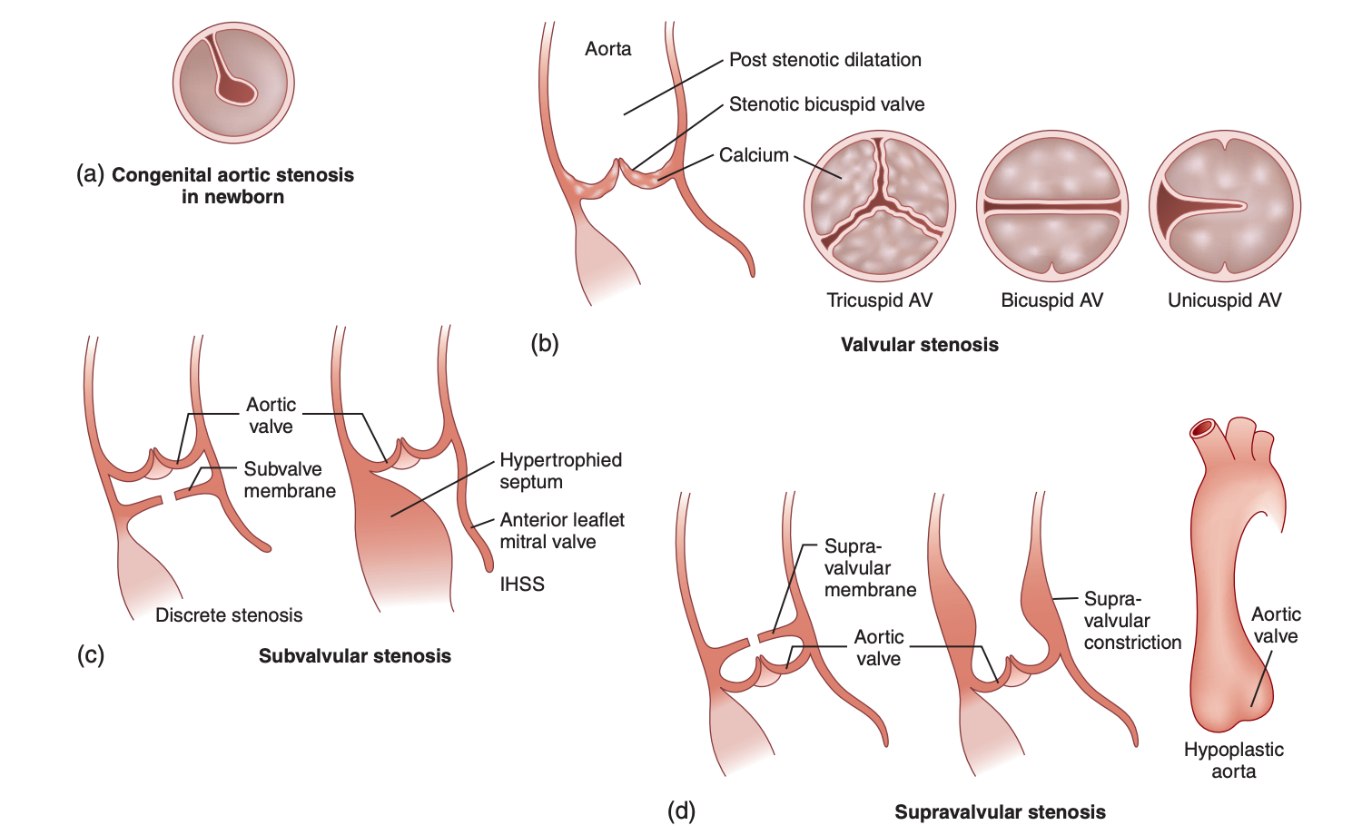 <p>Types of Left Ventricular Outflow Tract Obstruction