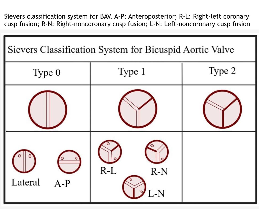 <p>Sievers Classification System for Bicuspid Aortic Valve