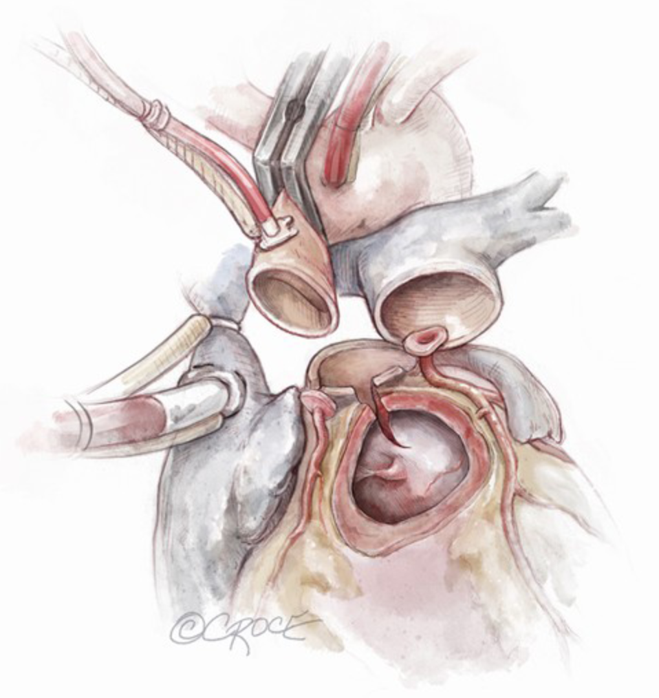 <p>Ross-Konno procedure. This illustration depicts a Konno incision in the interventricular septum.</p>