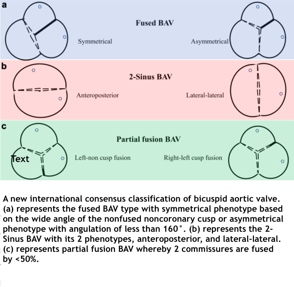 <p>International Consensus Classification for Bicuspid Aortic Valve