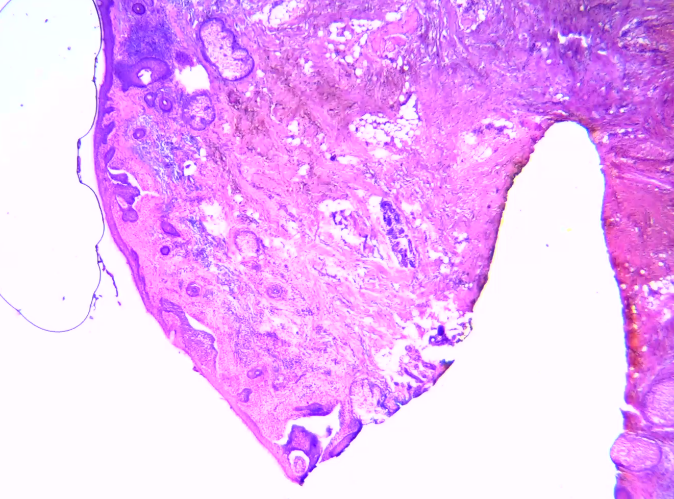 <p>Mohs Procedure Stage&nbsp;1. Superficial basal cell carcinoma on the nasal&nbsp;sidewall</p>