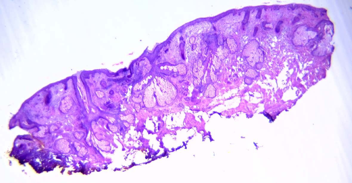 <p>Mohs Procedure Stage 3. Absence of basal cell carcinoma on the nasal sidewall</p>