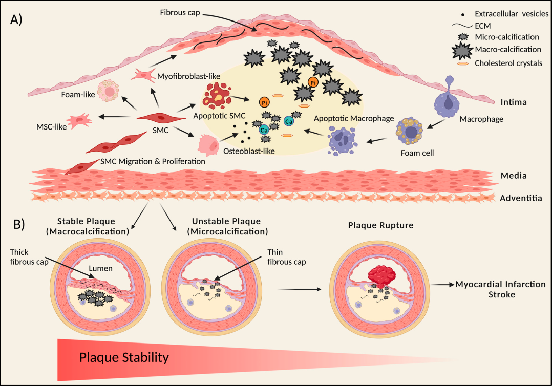 <p>Atherosclerotic Plaque Formation