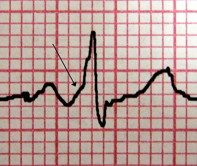 <p>Wolff-Parkinson-White Syndrome. A characteristic delta wave is seen in a patient with WPW. Note the short PR interval.</p>