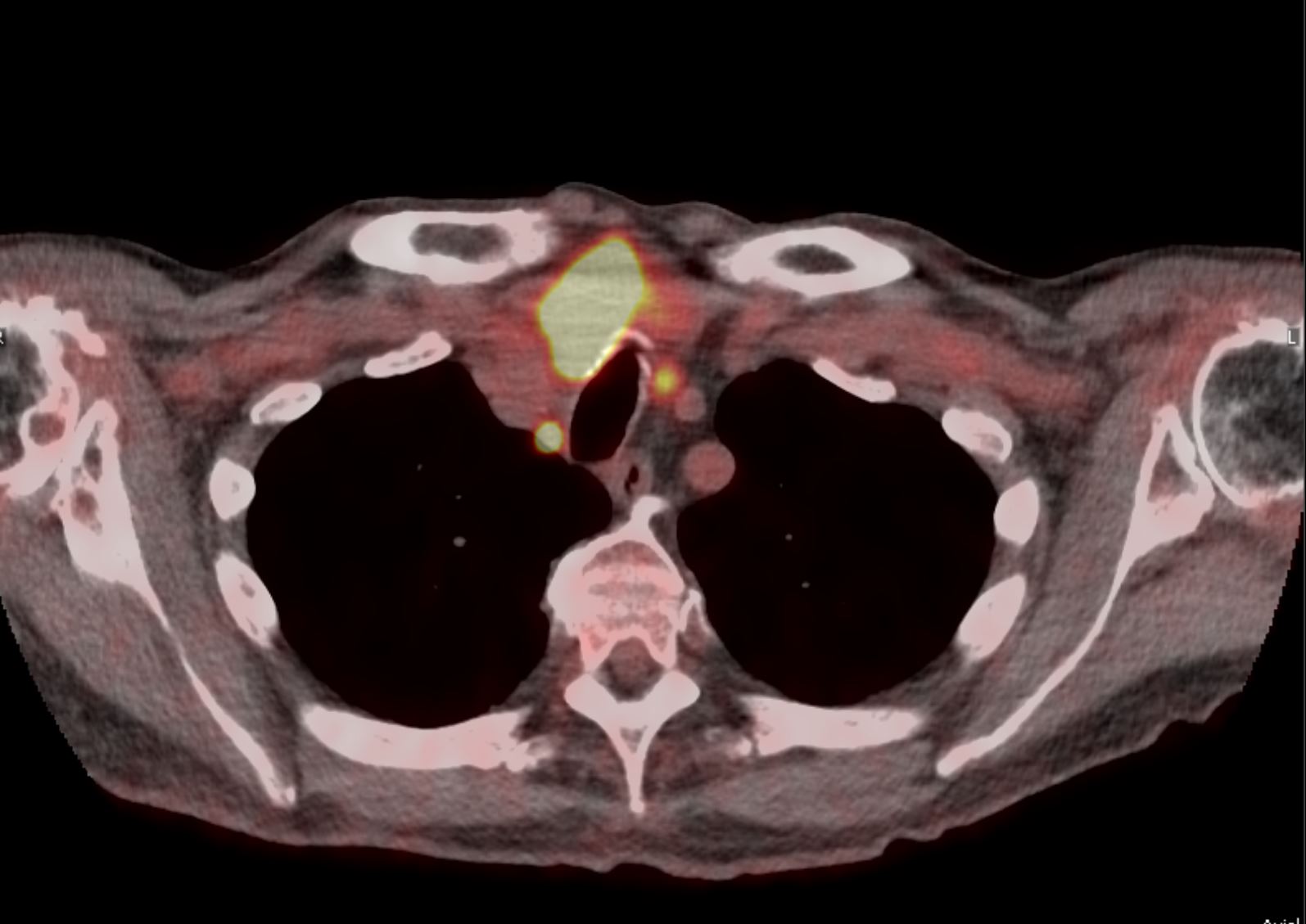 <p>Hypermetabolic Thyroid Mass, Positron Emission Tomography-Computed Tomography Scan (PET-CT)