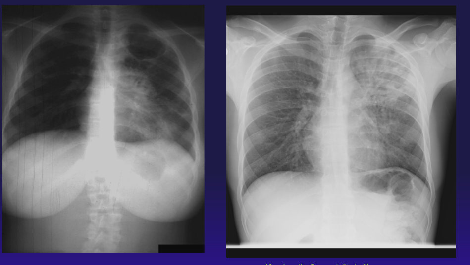 <p>Adult-Type Cavitary Tuberculosis Disease