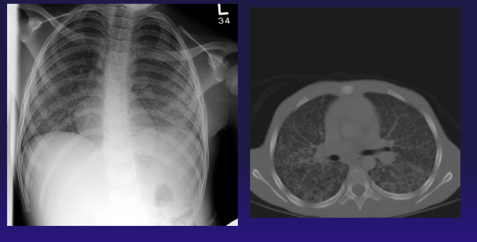 <p>Chest Radiograph and Computed Tomography, Tuberculosis