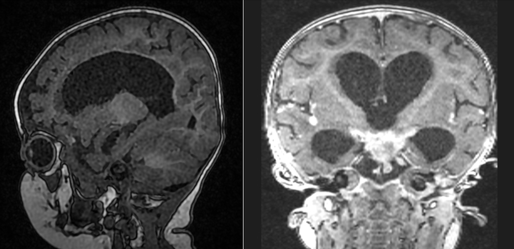 <p>Tuberculosis Meningitis