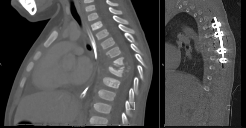 <p>Vertebral Osteomyelitis Due to Tuberculosis