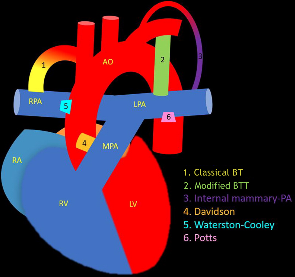 <p>Systemic-Pumonary Shunts