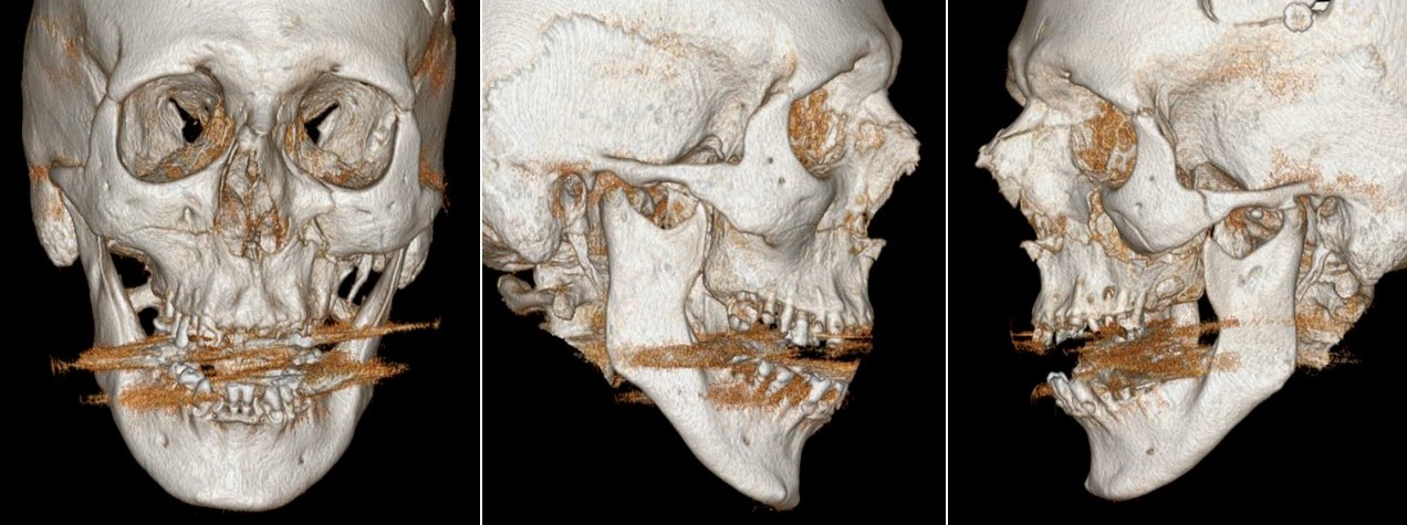 <p>Le Fort Fractures of the Midface